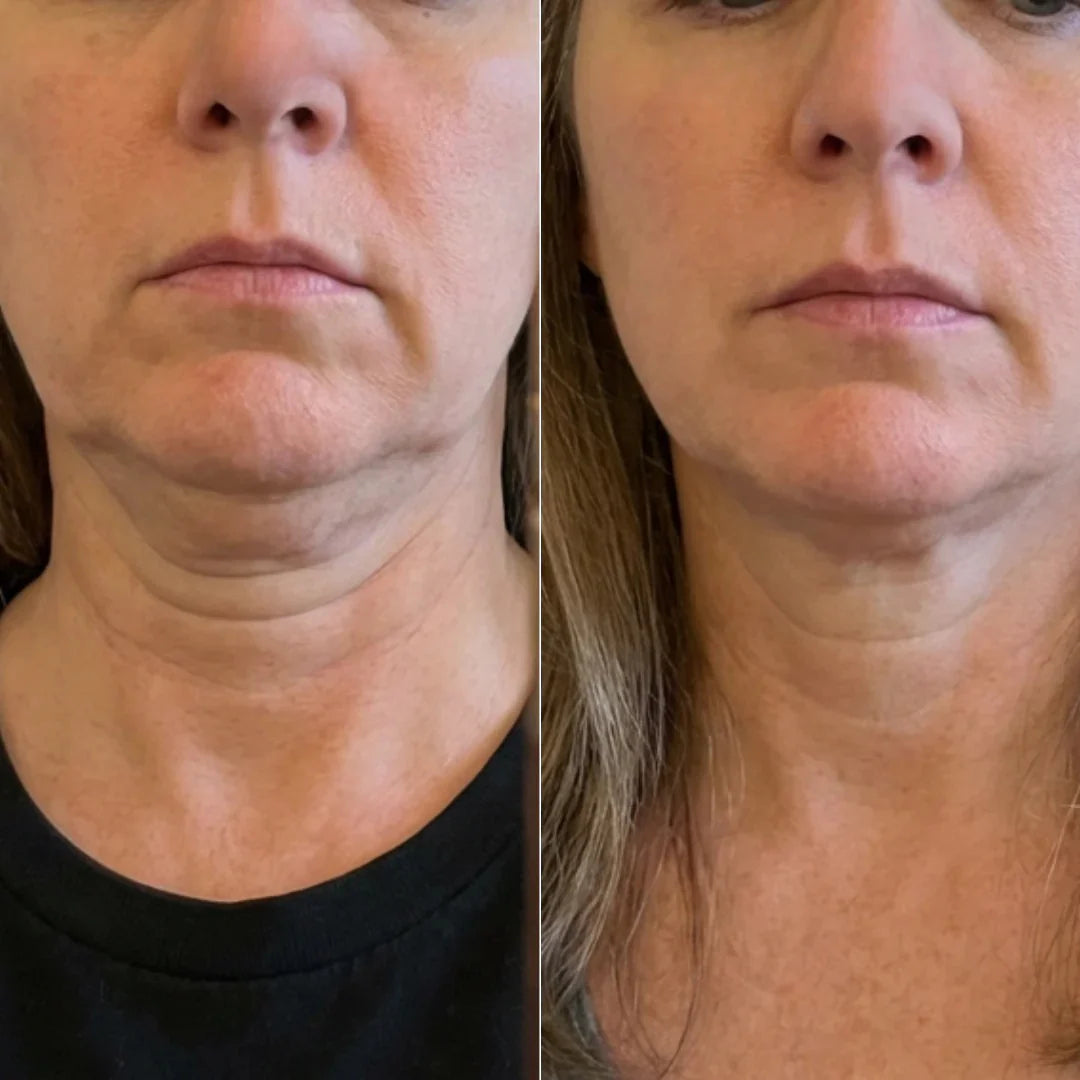 Antes / depois catherine